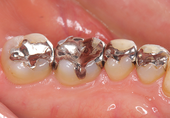 銀歯の持つさまざまなデメリット