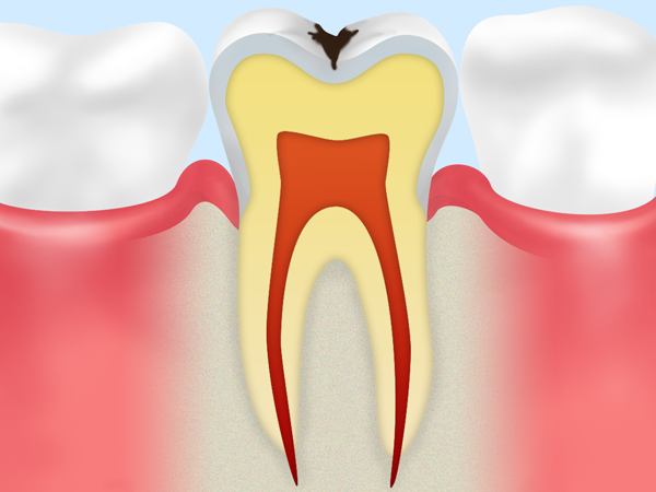 C1　初期の虫歯