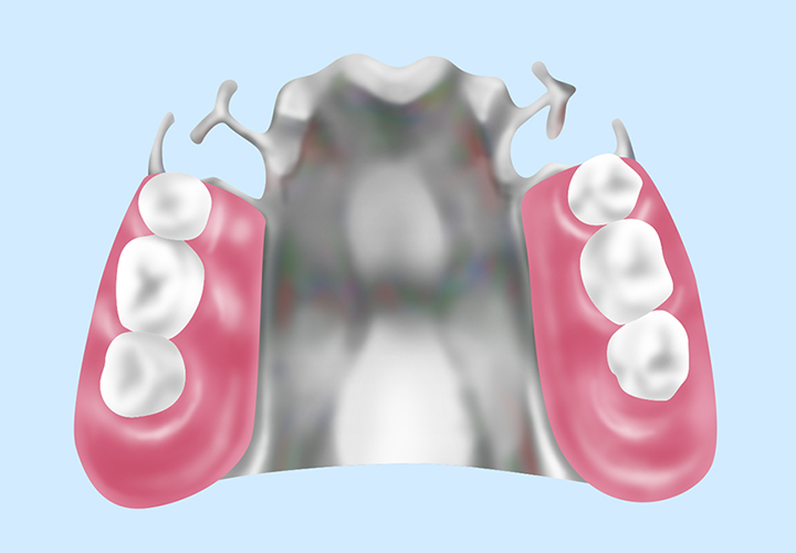 保険診療の入れ歯