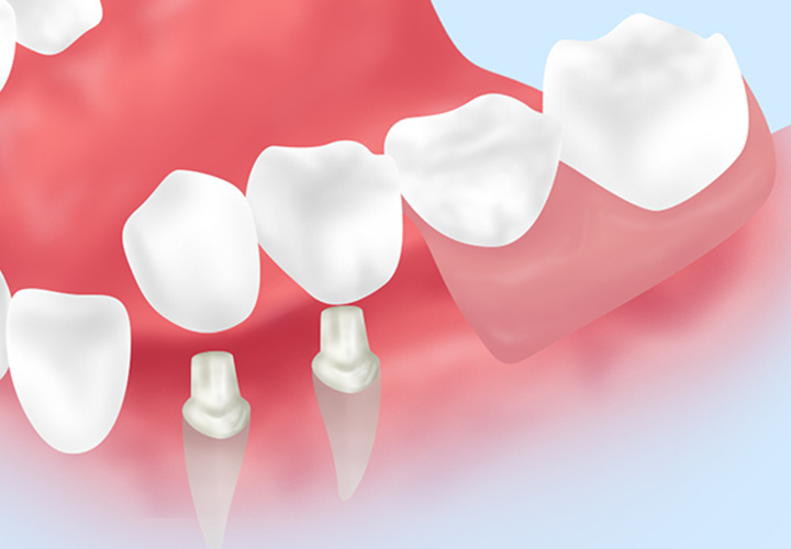 保険診療の入れ歯