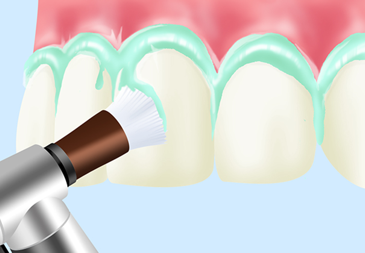 歯の隅々まできれいにする～PMTC～