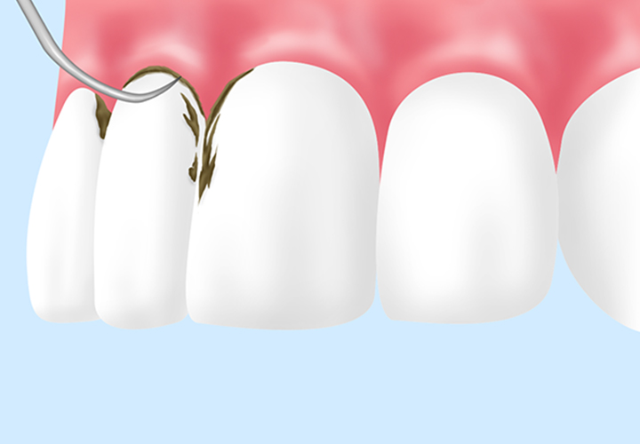 歯にこびりついた歯石を除去する～スケーリング～