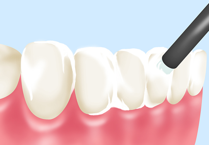 歯を強化して虫歯になりにくくする～フッ素塗布～