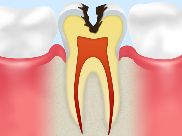 C2　本格的に進行し始めた虫歯