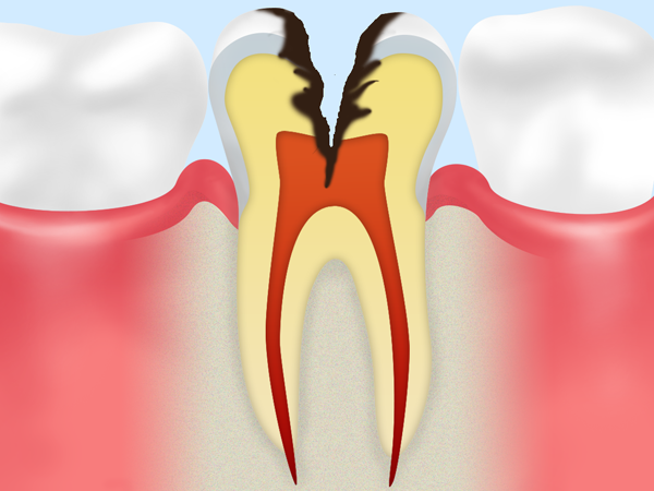 C3　神経まで進行した虫歯